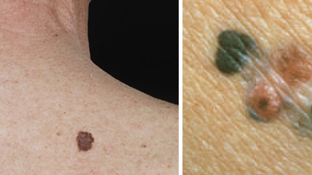 Två exempel på leverfläckar som misstänks vara malignt melanom.